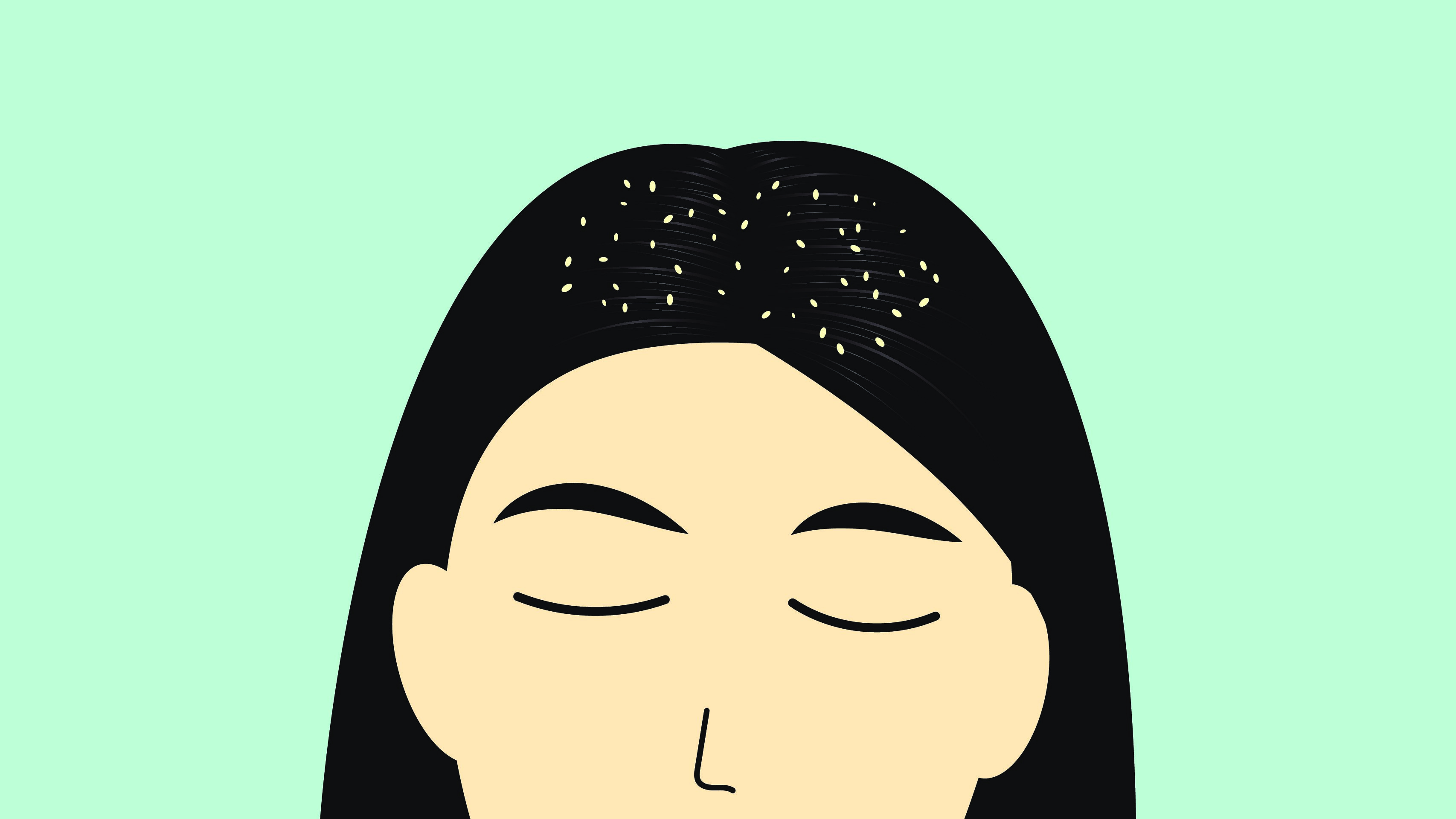 dandruff