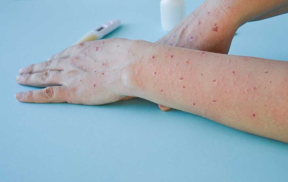 Monkeypox Outbreaks: Precautions To Reduce Your Risk | Healthy Wellbeing