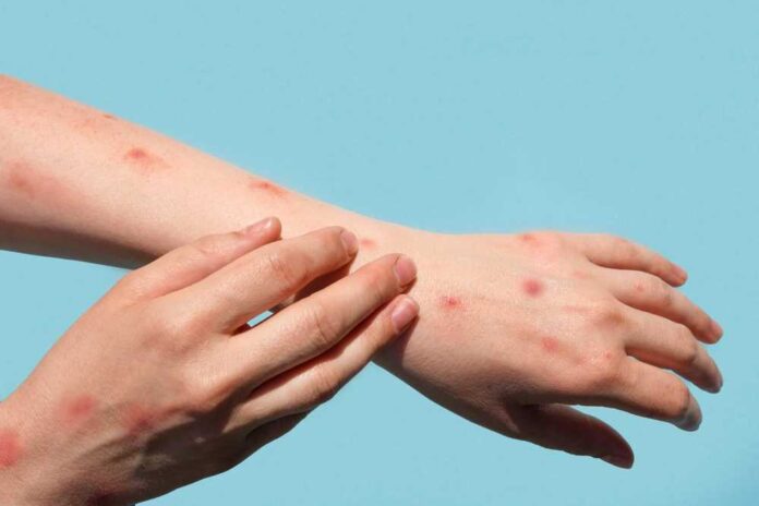 Monkeypox,New,Disease,Dangerous,Over,The,World.,Patient,With,Monkey