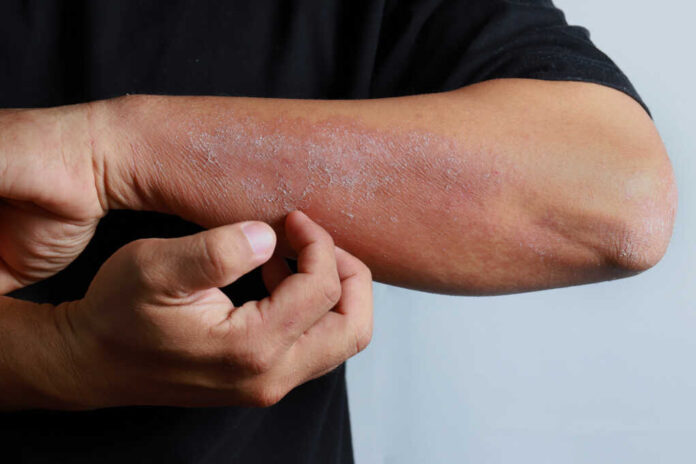 Close,Up,Dermatitis,On,Man,Hand,,Allergic,Rash,Dermatitis,Eczema