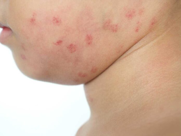 Red,Burn,Spot,Or,Scab,On,The,Face,Skin,And