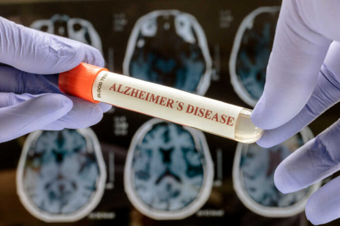 Scientist,Holds,Blood,Sample,To,Investigate,Remedy,Against,Alzheimer's,Disease,