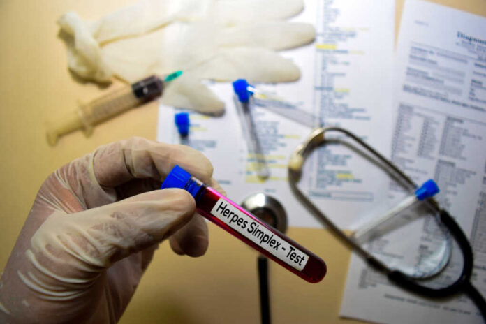 Herpes,Simplex,-,Test,With,Blood,Sample.,Top,View,Isolated