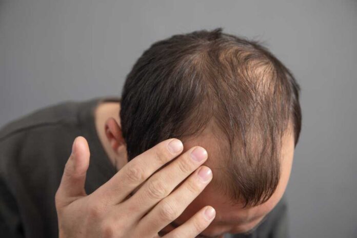 Caucasian,Man.,Hair,Loss,Problem